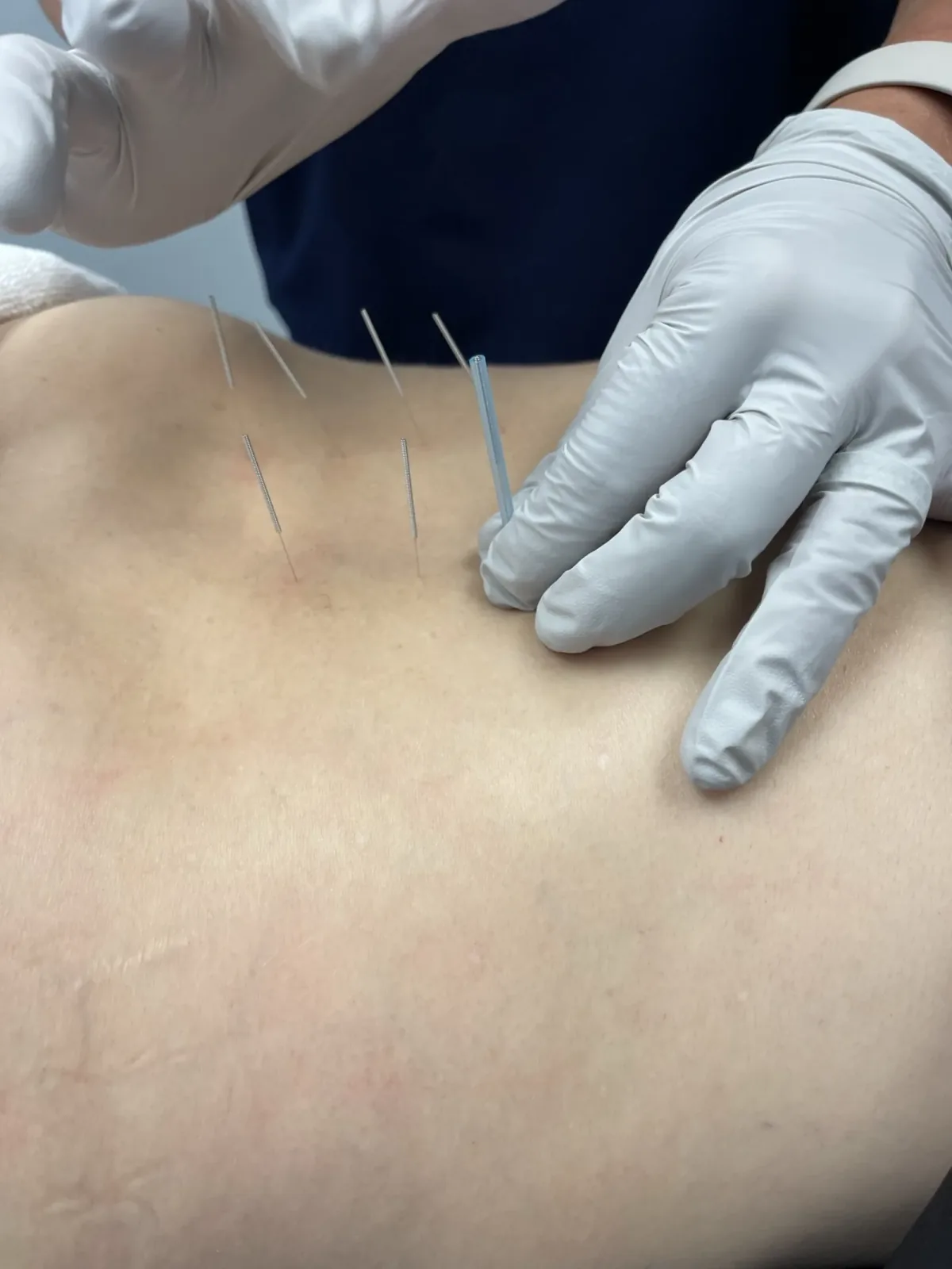 Dry needling treatment at Lakeside Sports Chiropractic