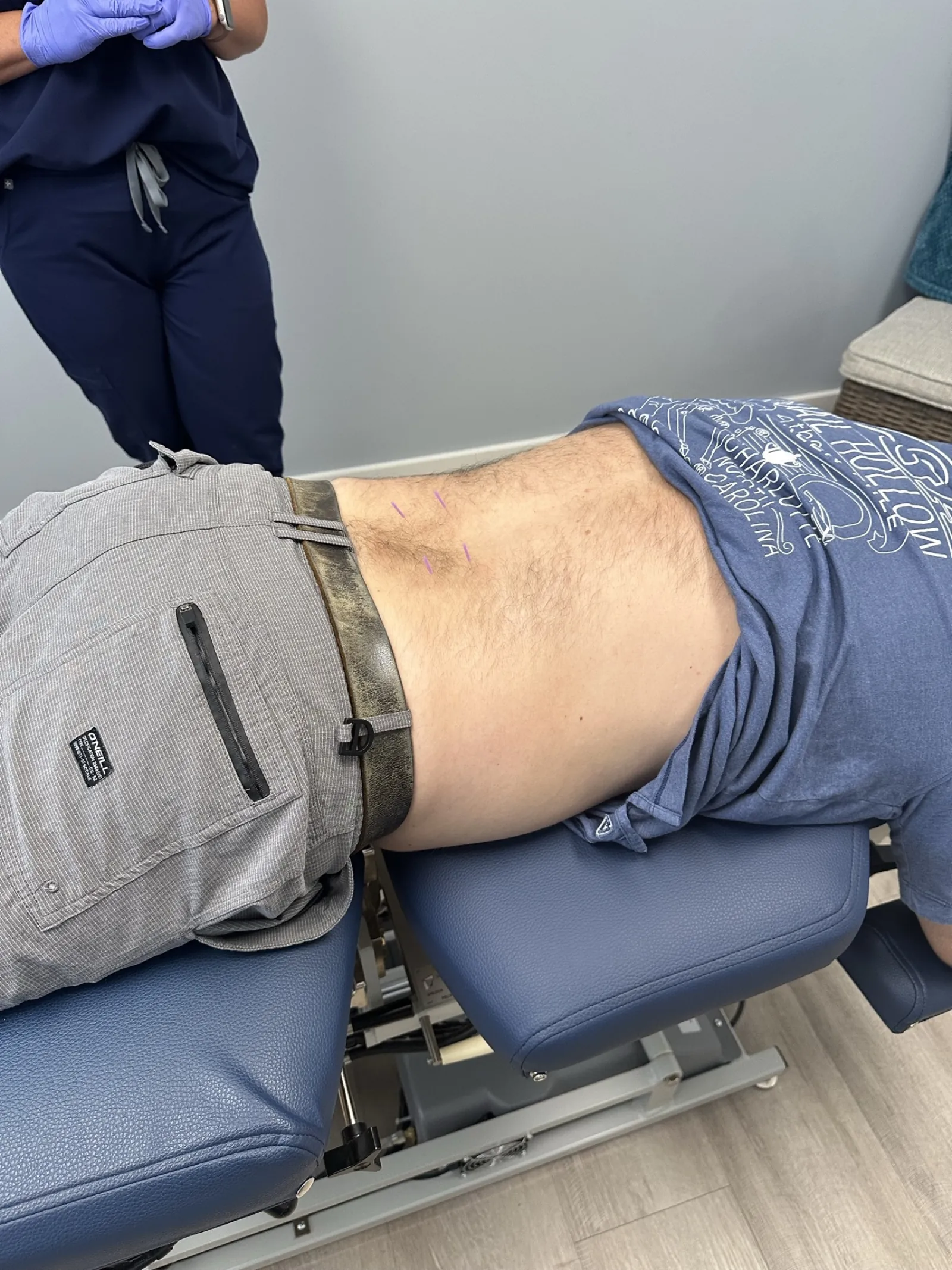 Dry needling treatment at Lakeside Sports Chiropractic