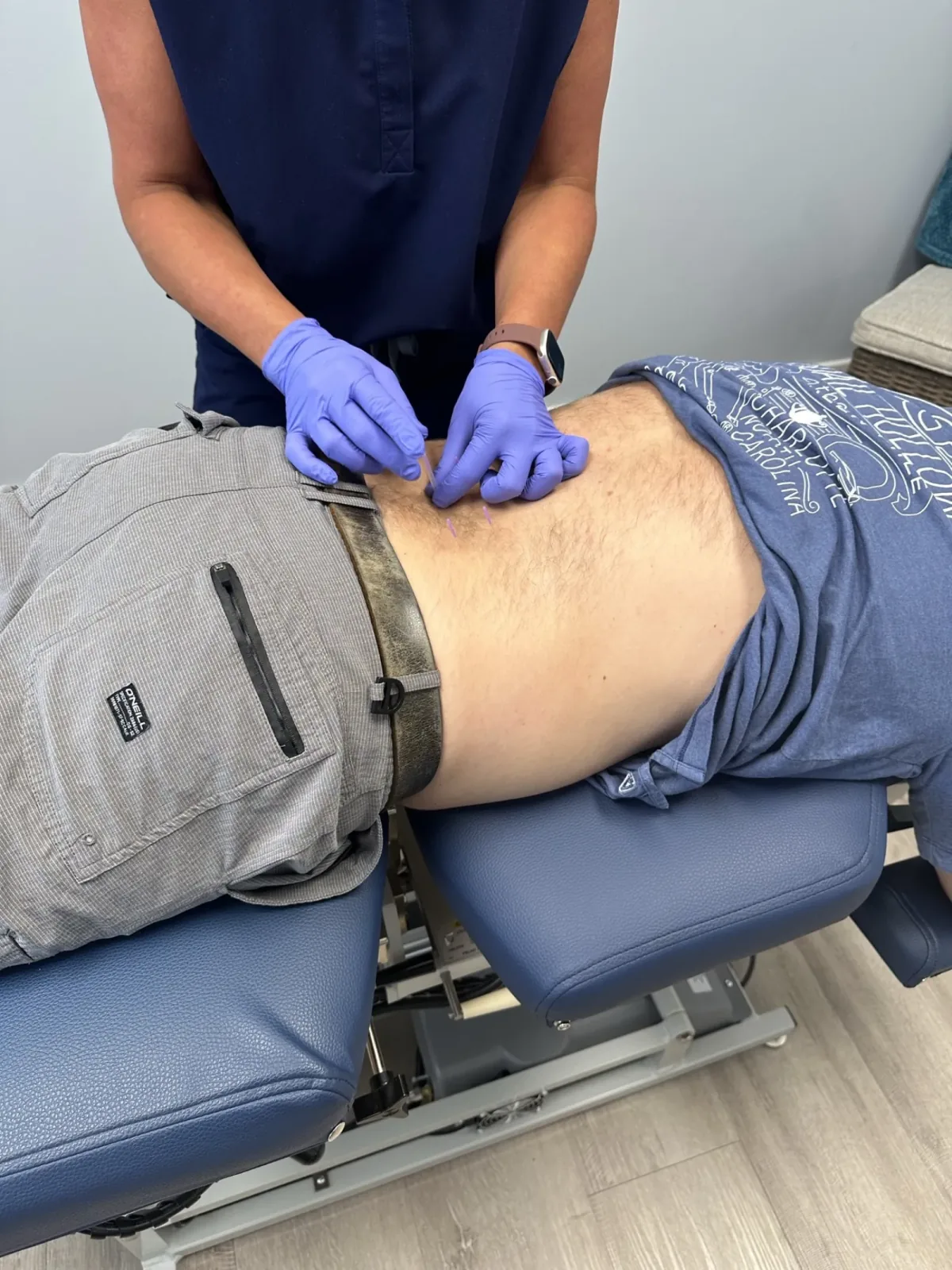 Dry needling treatment at Lakeside Sports Chiropractic