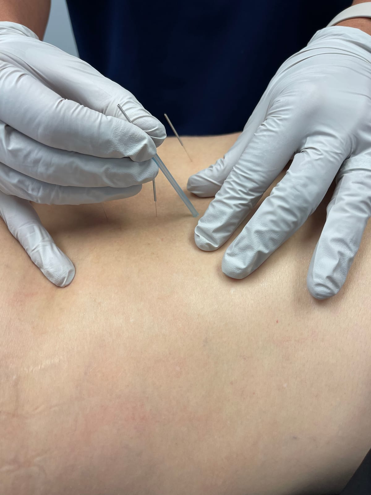 Dry needling at Lakeside Sports Chiropractic + Physical Therapy in Cornelius NC